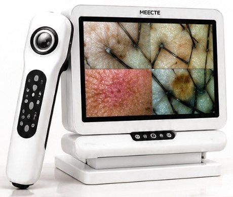 Equipo de dermatoscopia digital con análisis de imagen de la piel